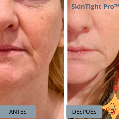 MASAJEADOR LED ANTIEDAD,  CUELLO Y ROSTRO  SKIN TIGHT PRO™  ⭐⭐⭐⭐⭐